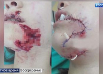 В Челнах наказали хозяйку собаки, растерзавшей лицо школьницы