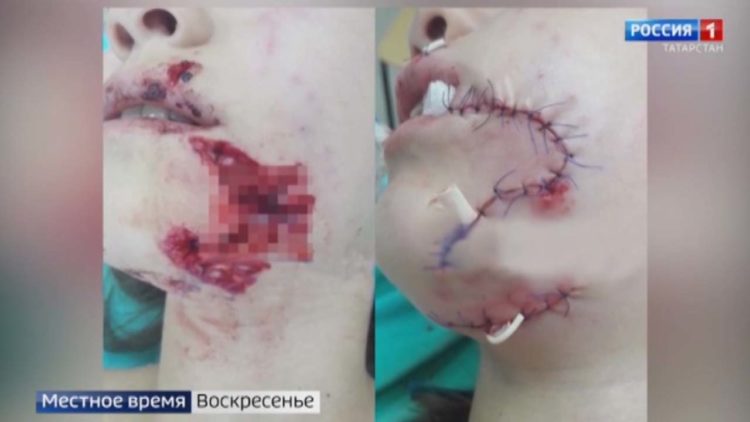 В Челнах наказали хозяйку собаки, растерзавшей лицо школьницы