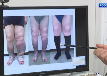 Надежда на исцеление: казанские ученые ищут причины возникновения «слоновой болезни»