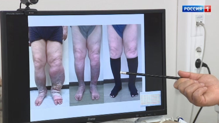 Надежда на исцеление: казанские ученые ищут причины возникновения «слоновой болезни»