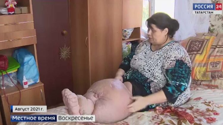 В Казань на лечение отправили женщину со «слоновой болезнью»