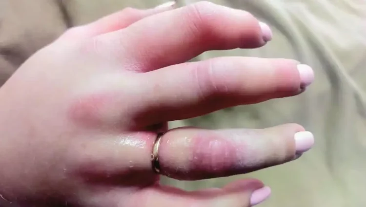 Челнинка попала в реанимацию после укуса гадюки на даче