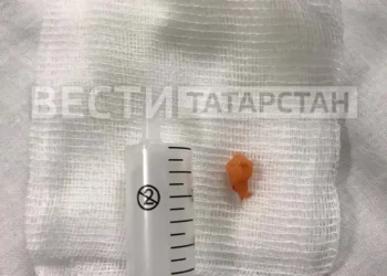 Врачи РКБ вытащили кусок моркови из легкого женщины