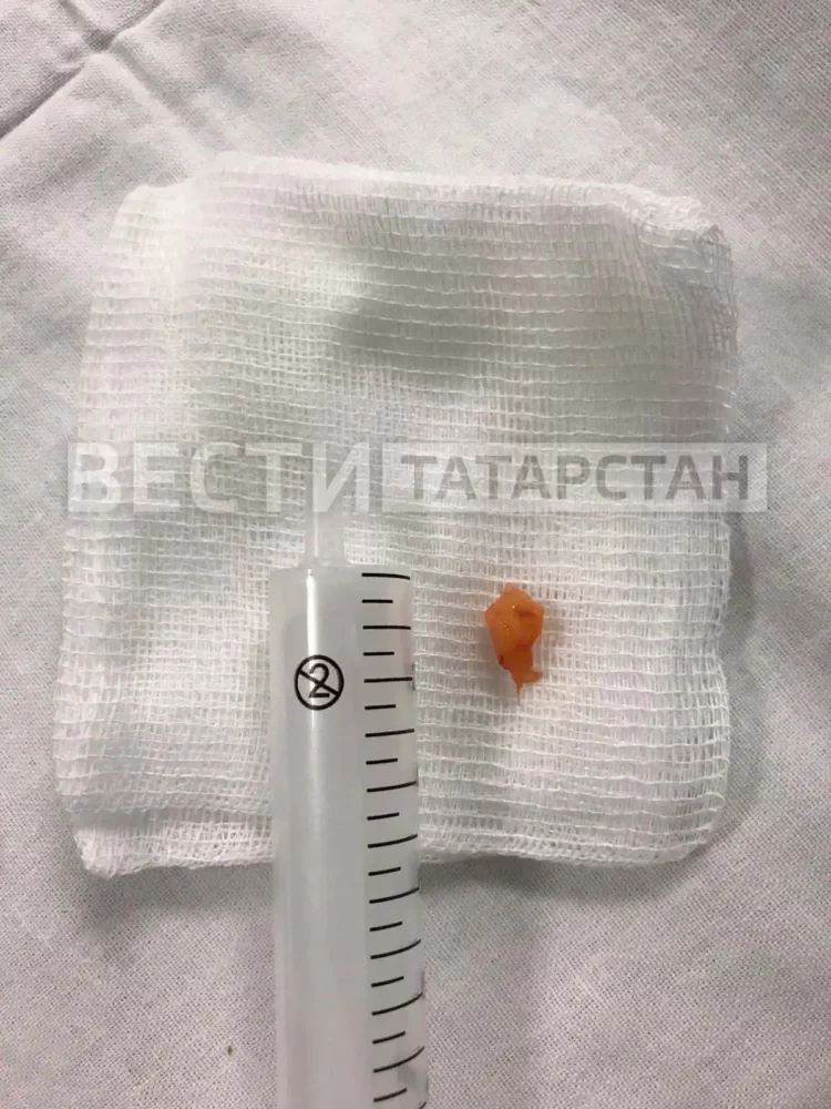 Врачи РКБ вытащили кусок моркови из легкого женщины