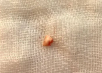 В Казани врачи удалили из бронха ребенка зуб