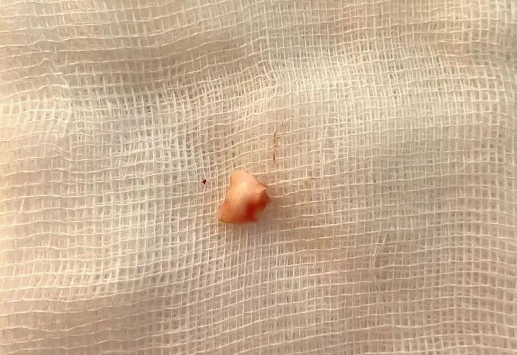 В Казани врачи удалили из бронха ребенка зуб