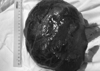 Врачи РКБ удалили у жительницы Казани огромную опухоль