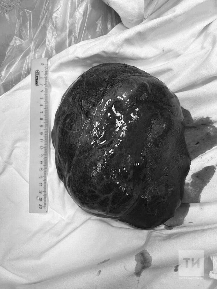 Врачи РКБ удалили у жительницы Казани огромную опухоль