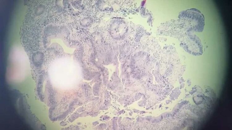 В онкодиспансере Челнов показали, как выглядят раковые клетки