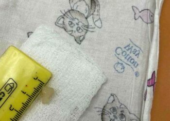 Врачи ДРКБ спасли годовалого ребёнка, подавившегося куском капусты