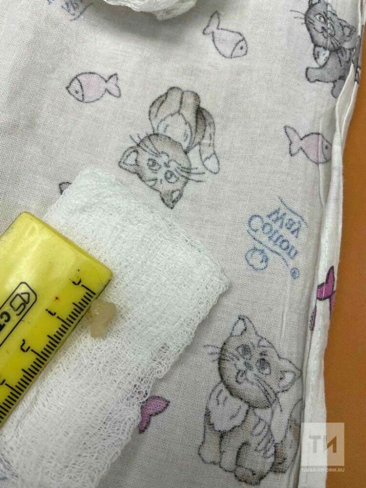 Врачи ДРКБ спасли годовалого ребёнка, подавившегося куском капусты