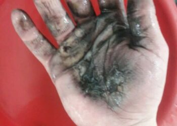 В Нижнекамске в руках молодого человека взорвалась электронная сигарета