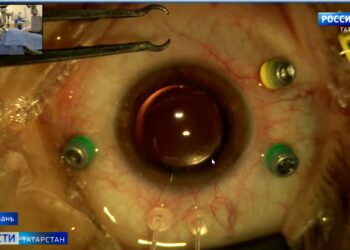 В Казани офтальмологи презентовали глазной хрусталик, который подходит всем