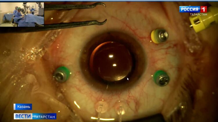В Казани офтальмологи презентовали глазной хрусталик, который подходит всем