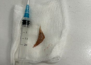 Врачи РКБ спасли казанца, которому рыбная кость разорвала пищевод