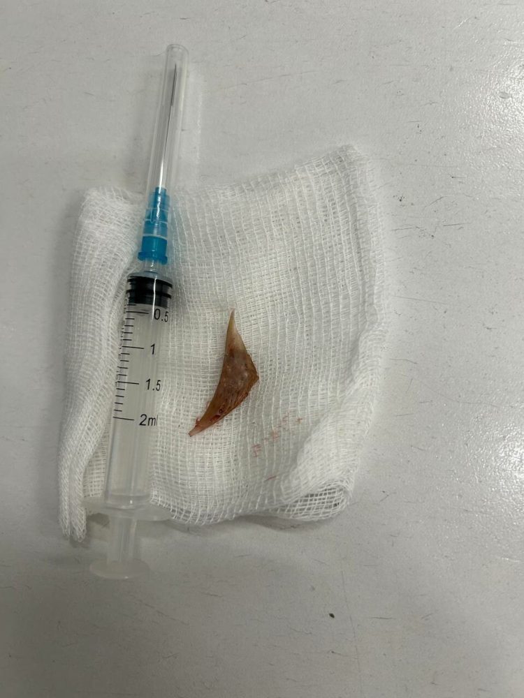 Врачи РКБ спасли казанца, которому рыбная кость разорвала пищевод