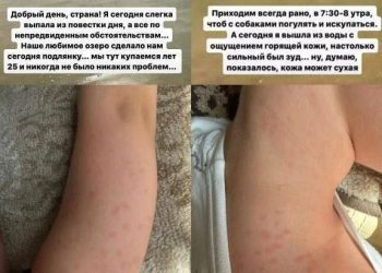 Жители Казани покрылись сыпью после купания в Изумрудном озере