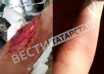 В Татарстане врачи БСМП спасли пациента, которого ужалила медуза