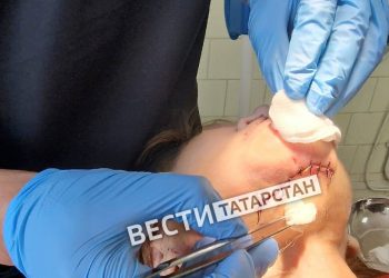 В Челнах хирурги заменили женщине отмершую челюсть на титановую