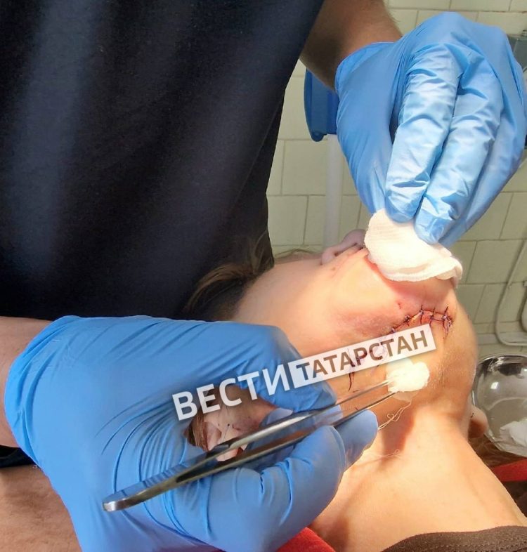 В Челнах хирурги заменили женщине отмершую челюсть на титановую