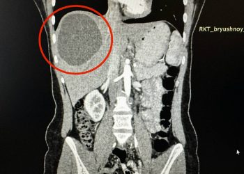 Врачи РКБ достали огромный ком червей из печени жительницы Казани