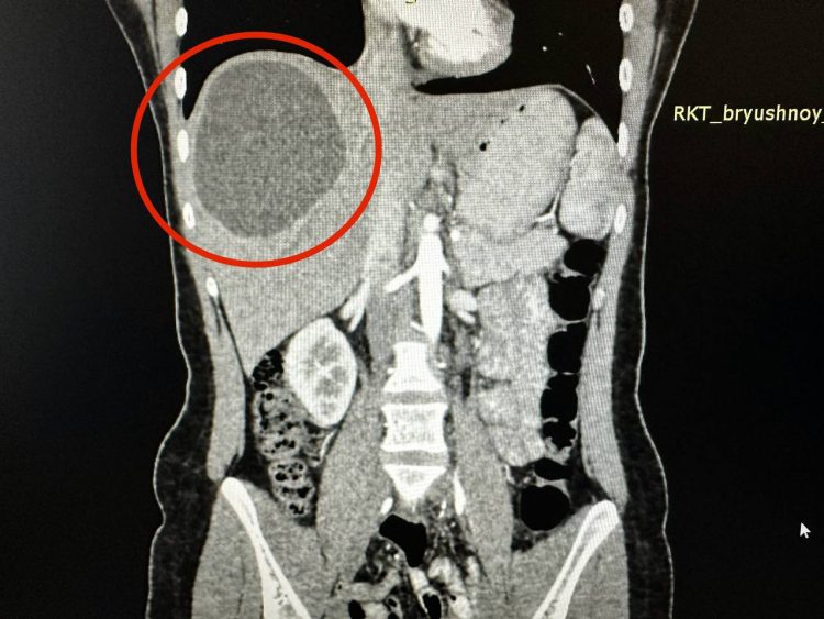 Врачи РКБ достали огромный ком червей из печени жительницы Казани
