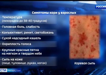 Вспышка кори в Казани и Зеленодольском районе: жителям настоятельно рекомендуют вакцинироваться