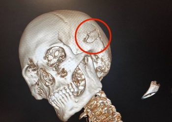 Врачи РКБ спасли мужчину, на которого рухнули металлические ворота