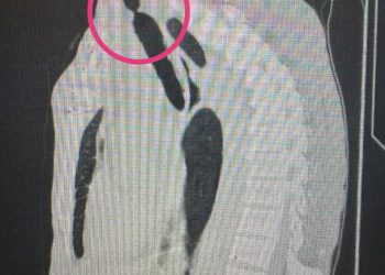 Врачи РКБ впервые провели стентирование трахеи у пациента