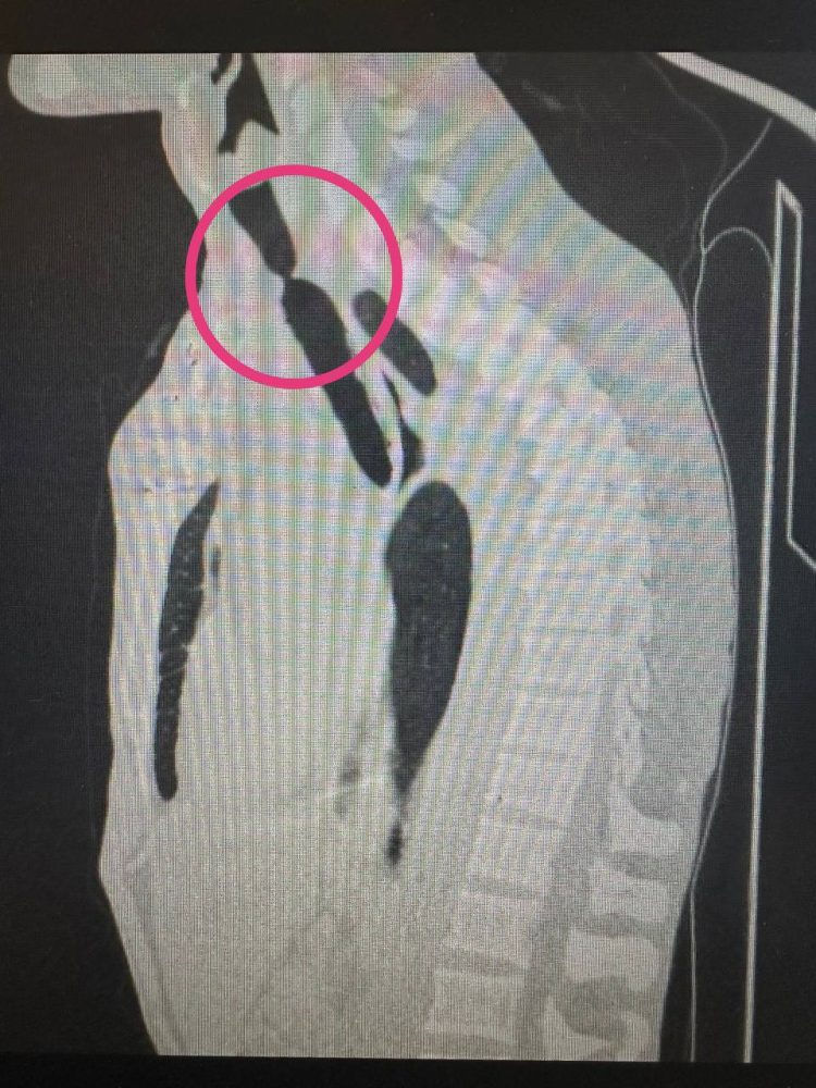 Врачи РКБ впервые провели стентирование трахеи у пациента