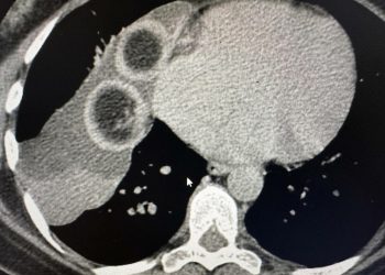 В Татарстане удалили кисту с клубками волос, которая выросла рядом с сердцем