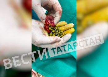 В Казани хирурги обнаружили в поджелудочной женщины около 50 камней