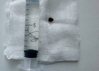 Врачи РКБ вытащили осколок со стенки аорты бойца СВО