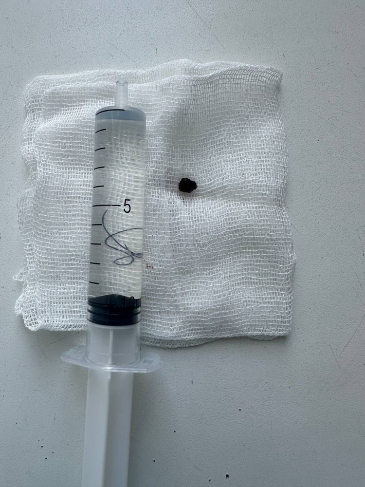 Врачи РКБ вытащили осколок со стенки аорты бойца СВО