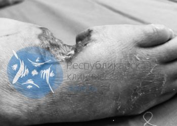 Микрохирурги РКБ восстановили стопу бойцу СВО