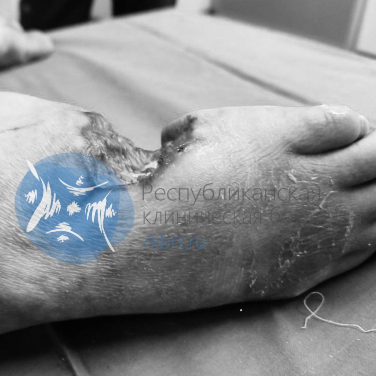 Микрохирурги РКБ восстановили стопу бойцу СВО