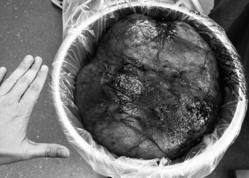 Врачи Татарстана удалили огромную опухоль из живота пенсионера