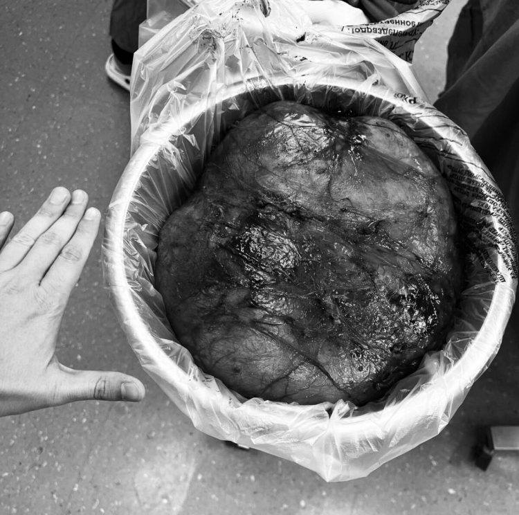 Врачи Татарстана удалили огромную опухоль из живота пенсионера