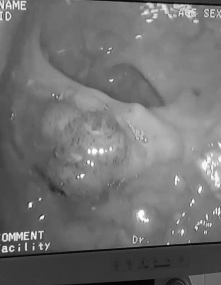 Врачи БСМП Челнов спасли мужчину, поступившего к ним с внутренним кровотечением